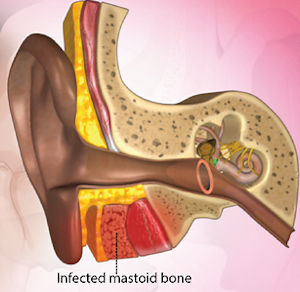 Inflamed mastoid bone - 21kB jpg
